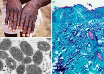 U.S. monkeypox cases on sharp rise as media blame government’s setbacks in containing outbreak