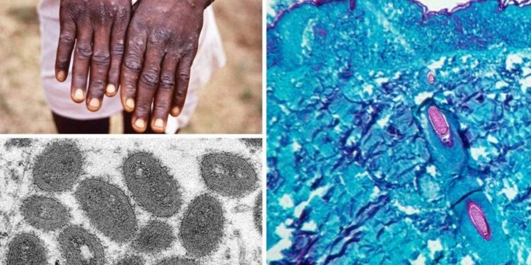 U.S. monkeypox cases on sharp rise as media blame government’s setbacks in containing outbreak