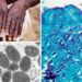 U.S. monkeypox cases on sharp rise as media blame government’s setbacks in containing outbreak